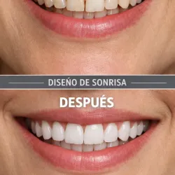 Diseño Sonrisa en Resina 