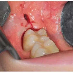 Exodoncia de 3ros molares (Cordales)