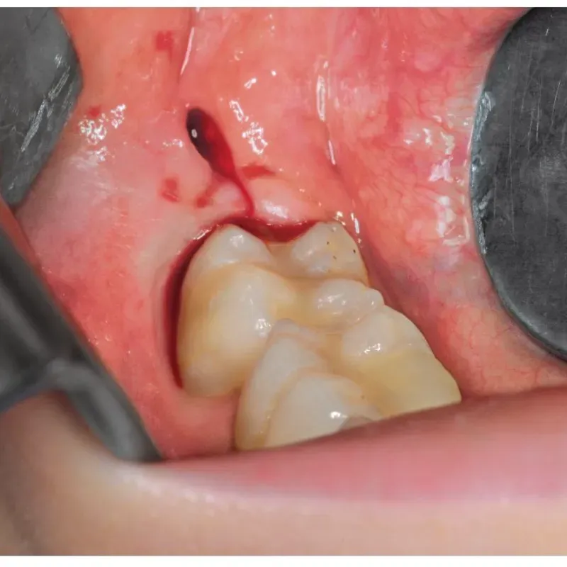 Exodoncia de 3ros molares (Cordales)