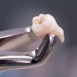 Exodoncia