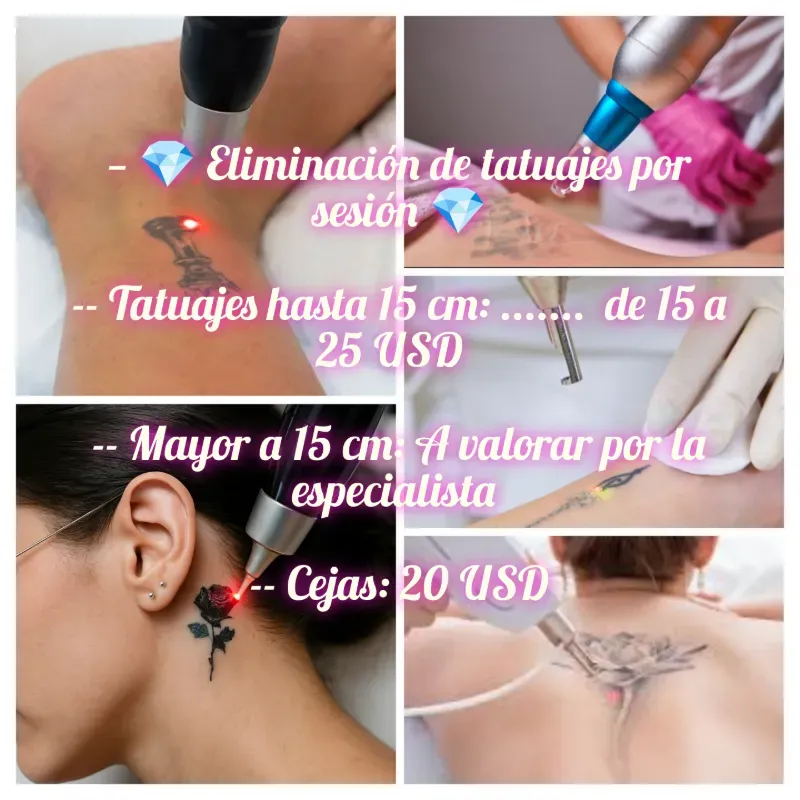 🔫 Eliminación de tatuajes con láser 