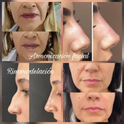 Filler de Ácido Hialurónico