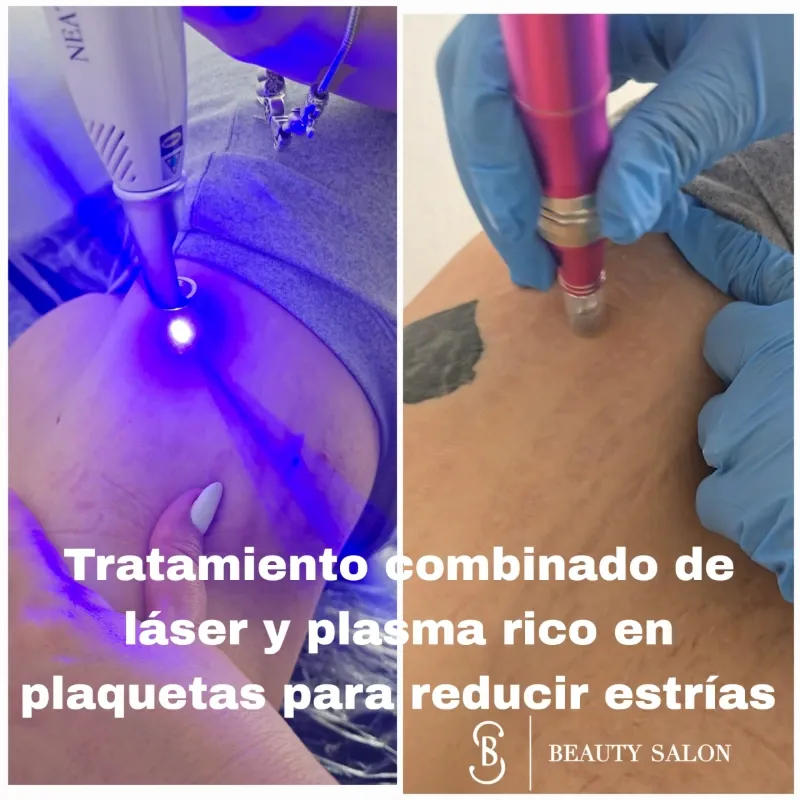 🖊️ Láser azul