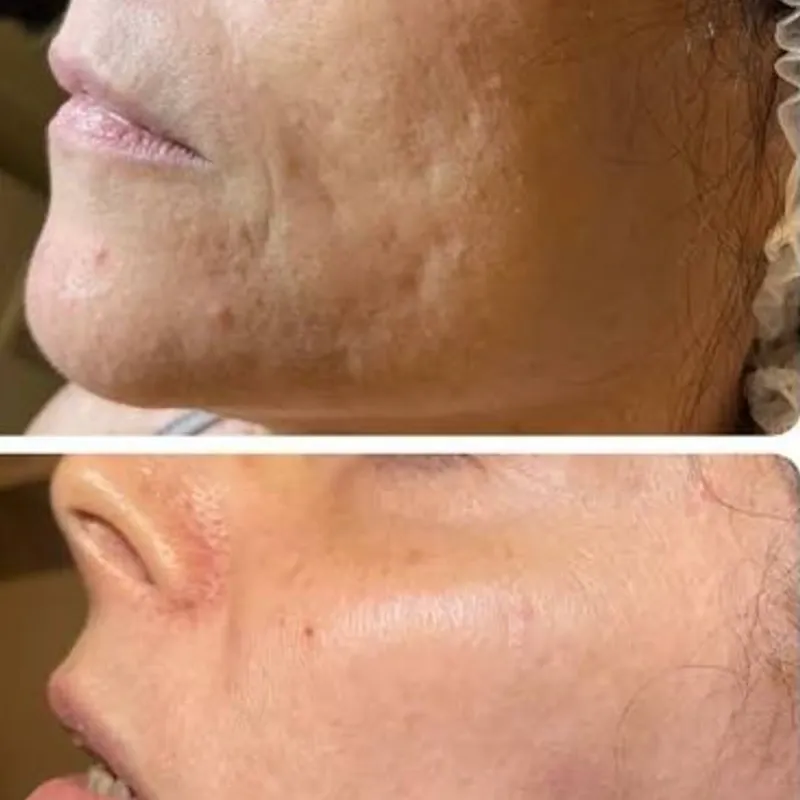 -💜 Mesobotox💜