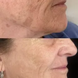 -💜 Mesobotox💜