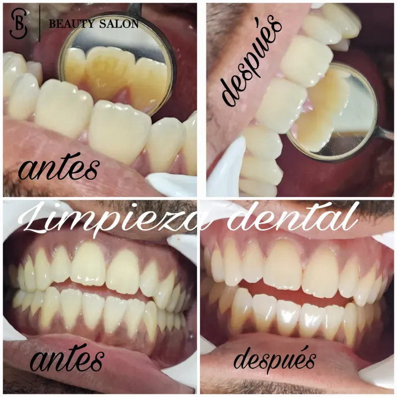 Solo Limpieza dental 