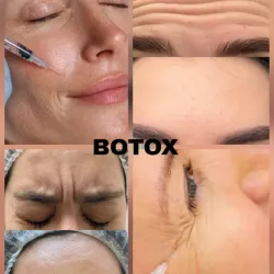 Toxina Butulínica (Botox)