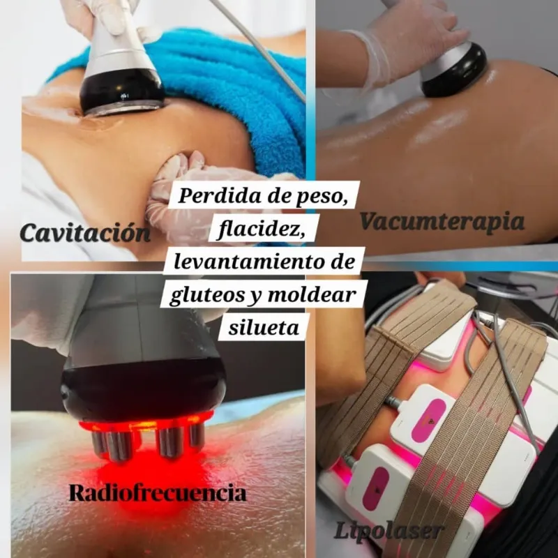 Ultracavitación + Lipoláser 