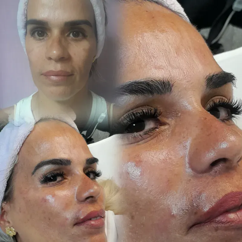 Armonización facial 