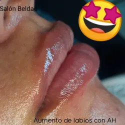 Aumento de labios con Ácido Hialurónico 