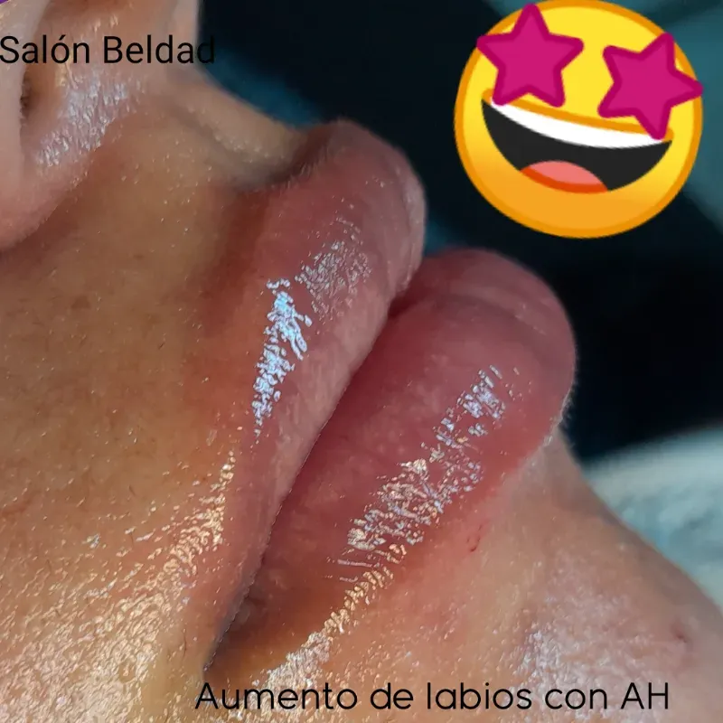 Aumento de labios con Ácido Hialurónico 