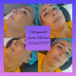 Collagen lift