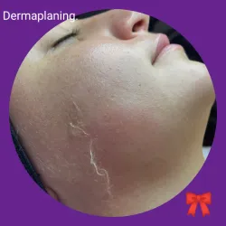 Dermaplaning