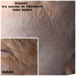 Fibroblast/Plasmapen 