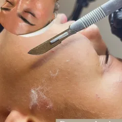 Limpieza facial con Dermaplaning