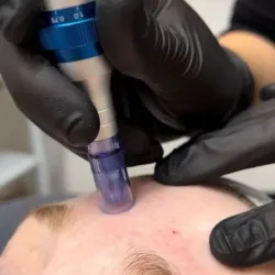 Microneedling 