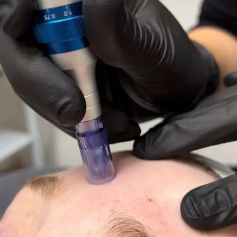 Microneedling 