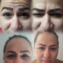 Toxina Botulínica (Botox)