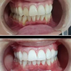 Blanqueamiento dental 