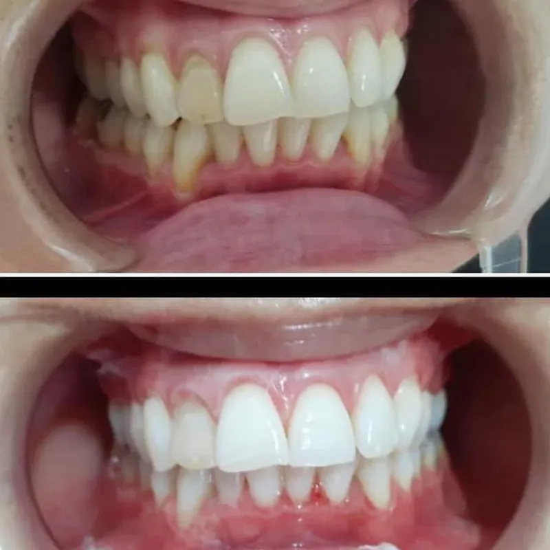 Blanqueamiento dental 