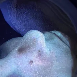 Análisis profundo cutáneo