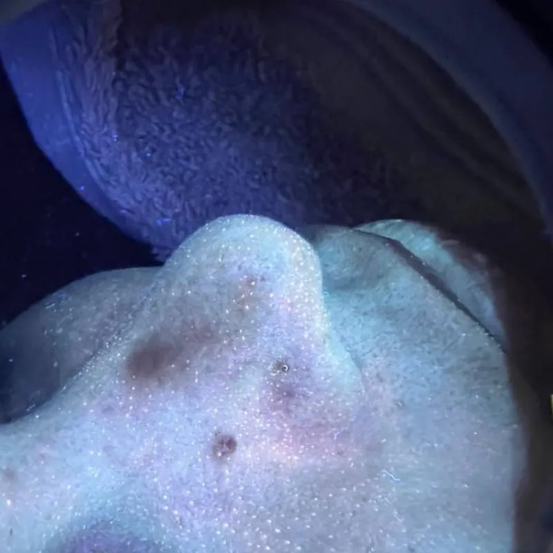 Análisis profundo cutáneo