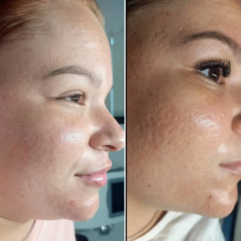 Biomicroneedling facial