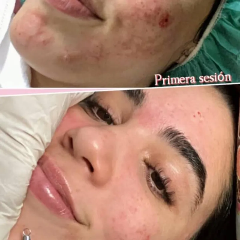 Biomicroneedling Facial + Higiene Facial Profunda