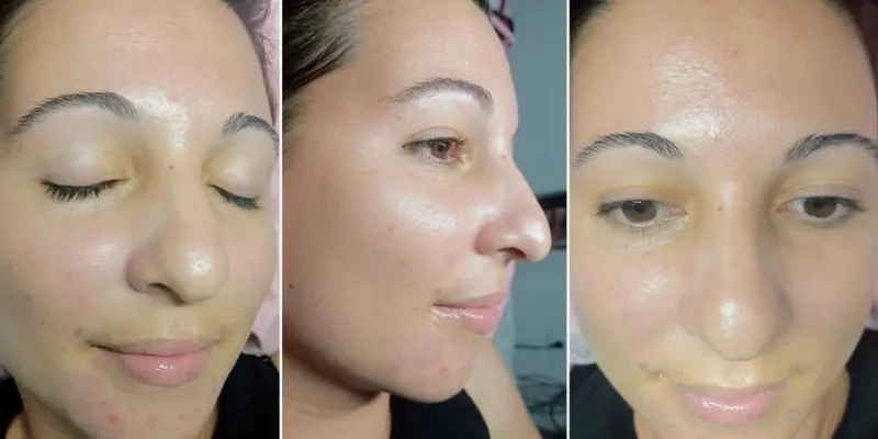 Biomicroneedling Facial