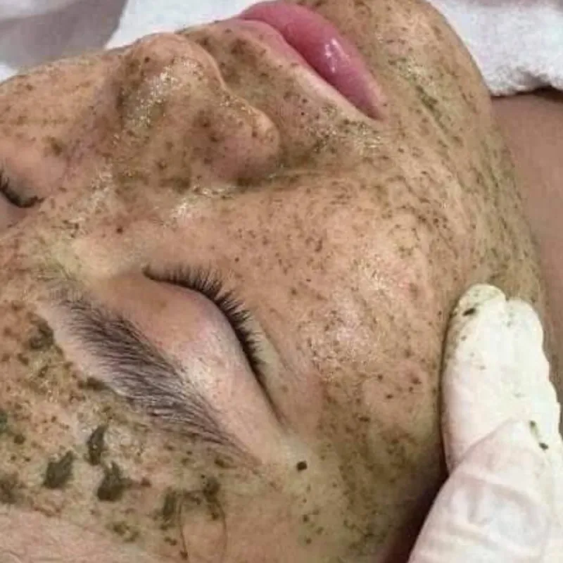 Biomicroneedling Facial