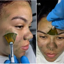 Biomicroneedling facial