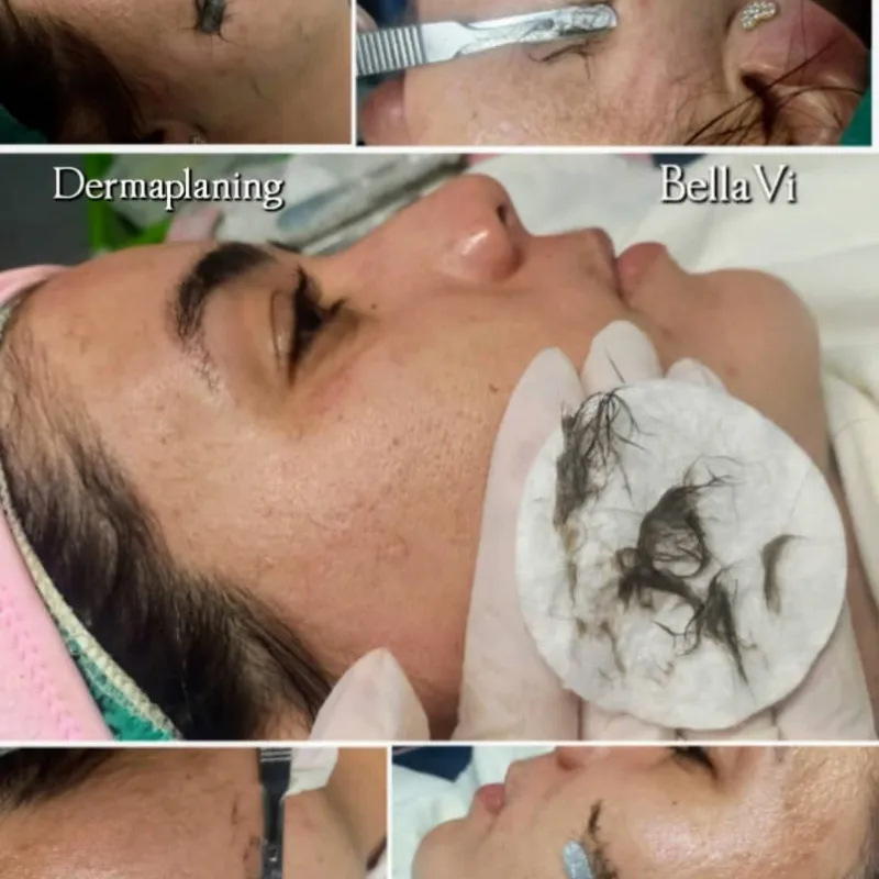 Dermaplaning Facial