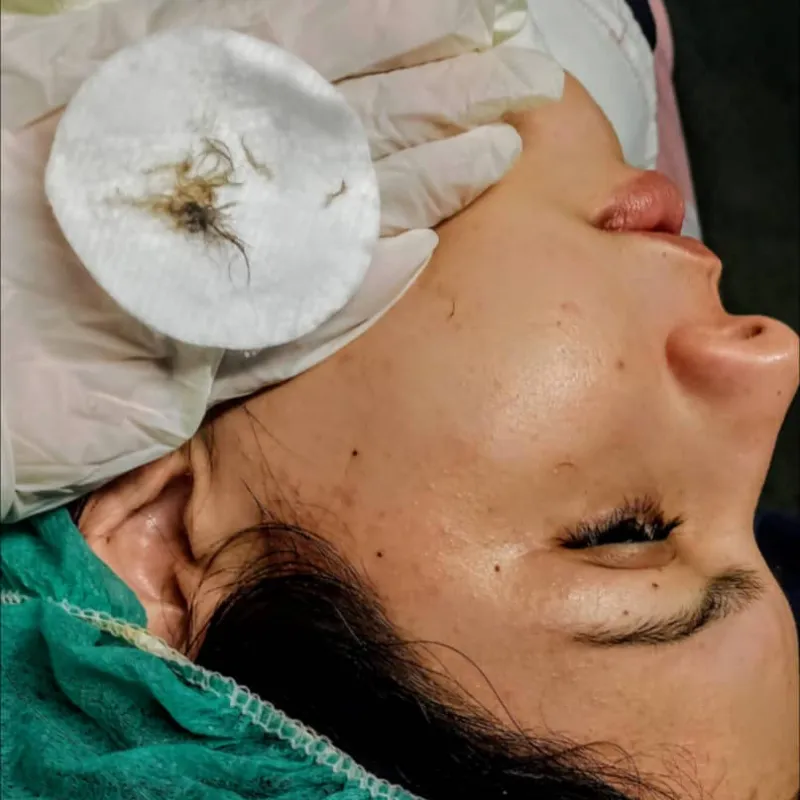 Dermaplaning Facial