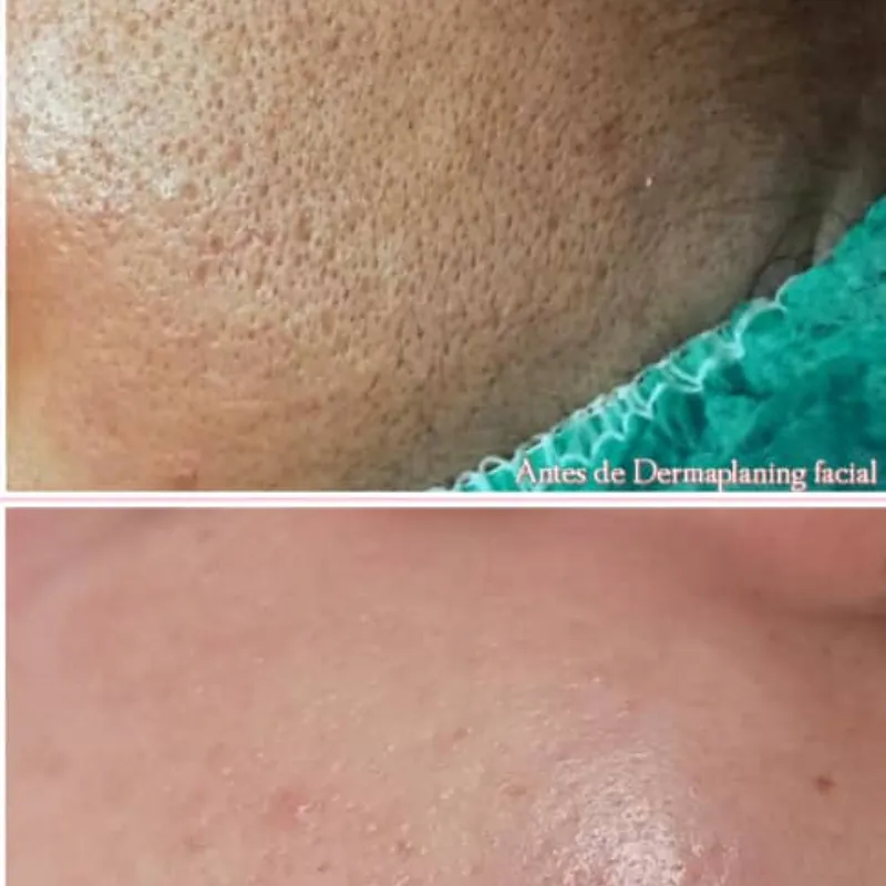 Dermaplaning Facial