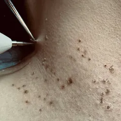 Eliminación de Verrugas