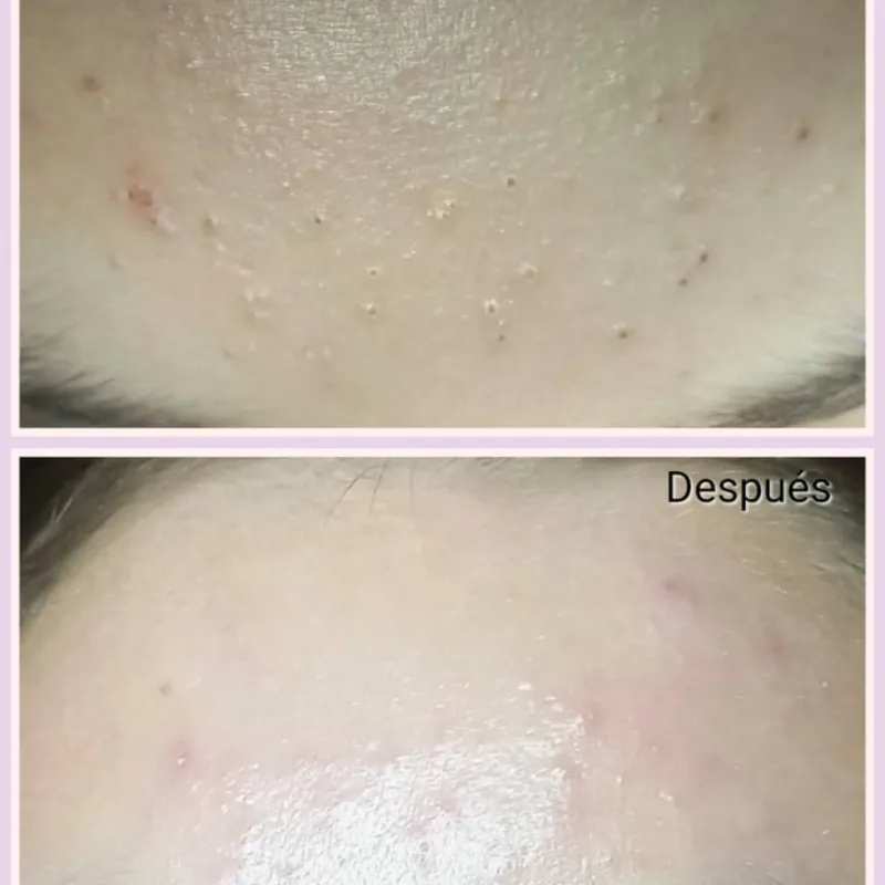 Limpieza Facial Profunda