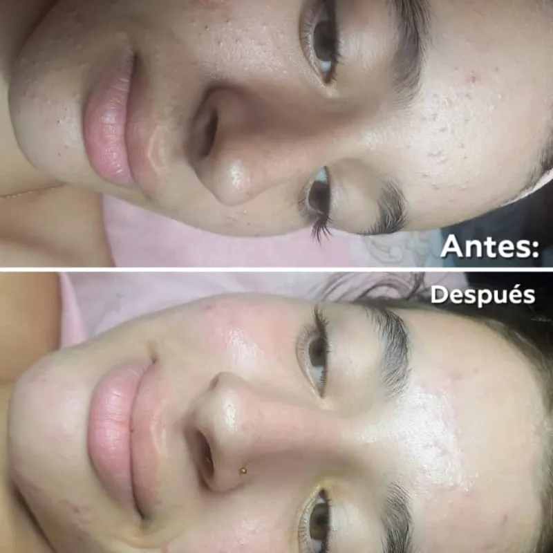 Limpieza Facial Profunda