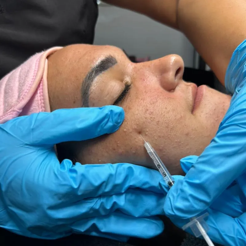 Mesoterapia facial