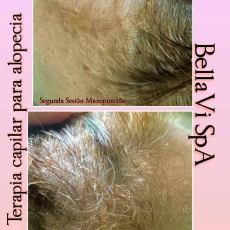 Micropunción con Activos