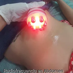 Radiofrecuencia en Abdomen 