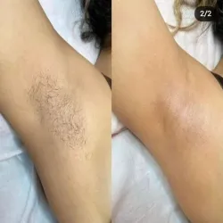 Depilación de axilas 