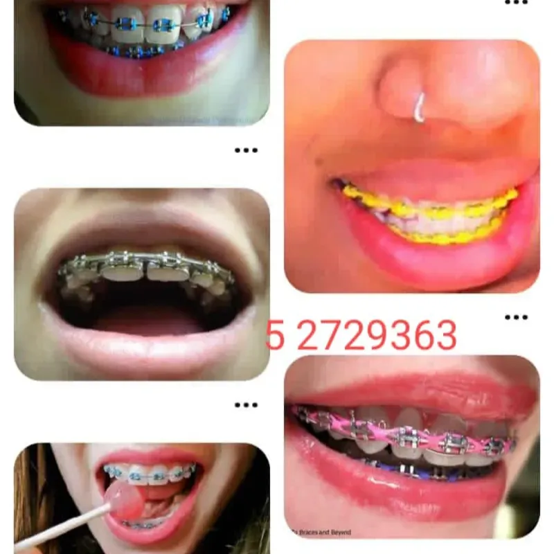 Brackets de Lujo 