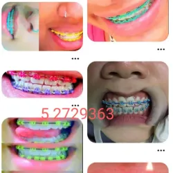 Brackets de Lujo 