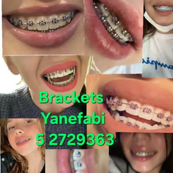 Venta de todo lo relacionado con Brackets  (Aparatos Dentales) Técnica fija, sus accesorios y material de Ortodoncia. Somos la tienda perfecta para una compra segura de tus productos y sobre todo con Calidad garantizada. 