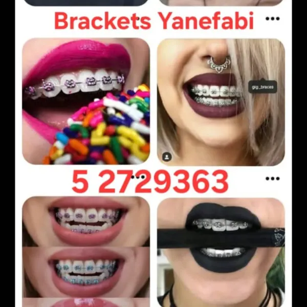 Venta de todo lo relacionado con Brackets  (Aparatos Dentales) Técnica fija, sus accesorios y material de Ortodoncia. Somos la tienda perfecta para una compra segura de tus productos y sobre todo con Calidad garantizada. 