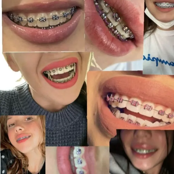 Venta de todo lo relacionado con Brackets  (Aparatos Dentales) Técnica fija, sus accesorios y material de Ortodoncia. Somos la tienda perfecta para una compra segura de tus productos y sobre todo con Calidad garantizada. 