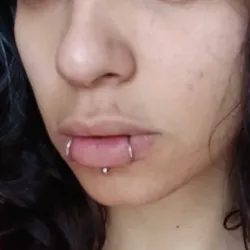 Snake bites (FALSAS) 
