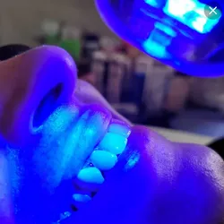 Blanqueamiento dental