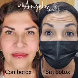 Botox en Rostro+Cuello.