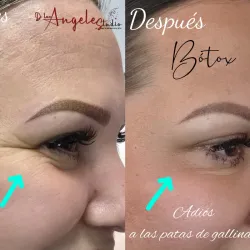 Botox en Tercio Superior del Rostro.